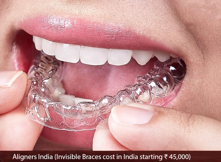 Invisible Braces Cost in India