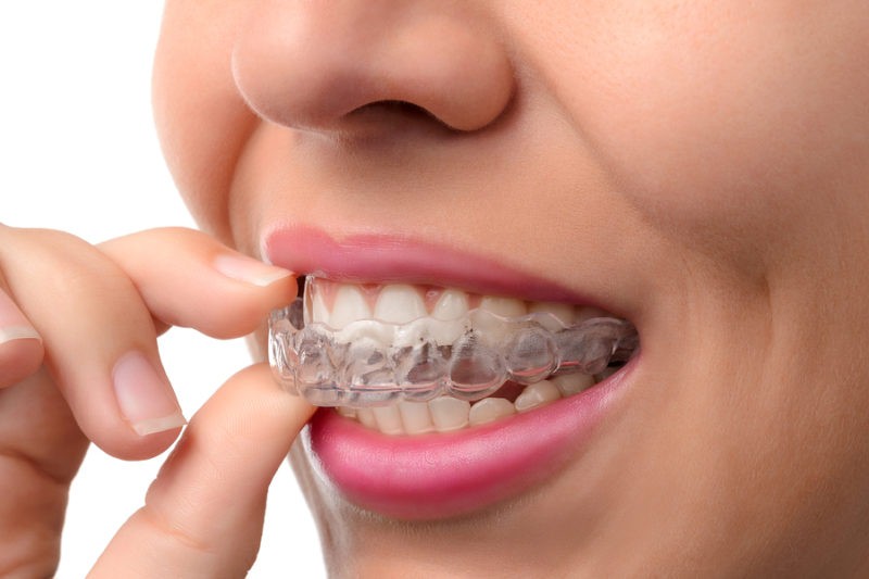 Invisible Braces Cost in India